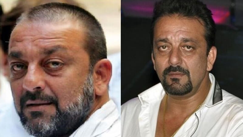 Sanjay Dutt Hair Transplant